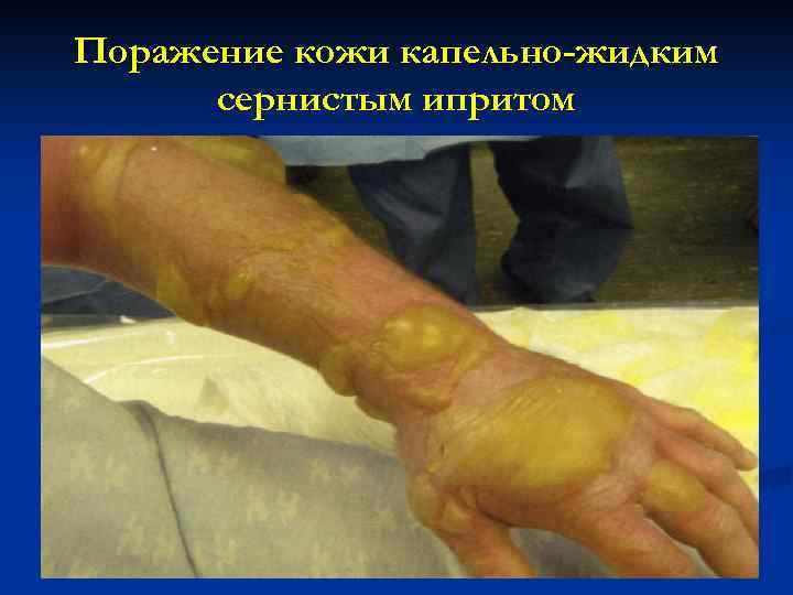 Поражение кожи капельно-жидким сернистым ипритом 