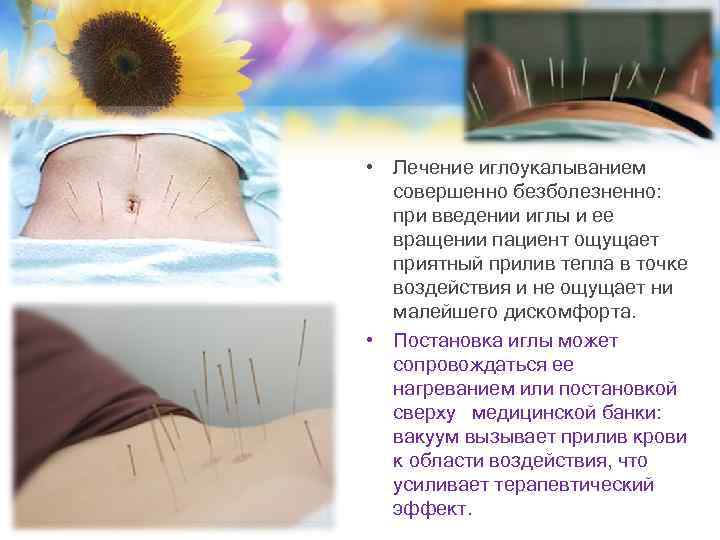  • Лечение иглоукалыванием совершенно безболезненно: при введении иглы и ее вращении пациент ощущает
