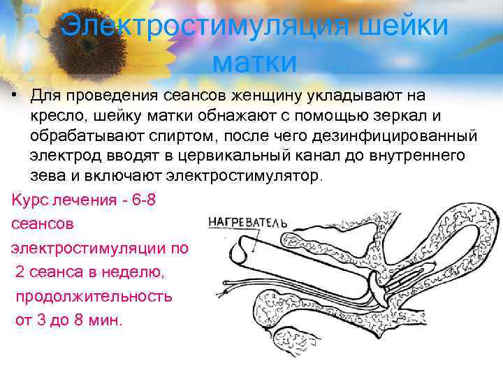 Электростимуляция шейки матки • Для проведения сеансов женщину укладывают на кресло, шейку матки обнажают