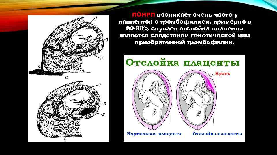 ПОНРП возникает очень часто у пациенток с тромбофилией, примерно в 80 -90% случаев отслойка