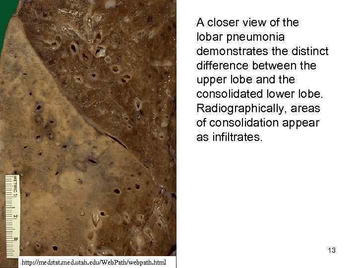 A closer view of the lobar pneumonia demonstrates the distinct difference between the upper