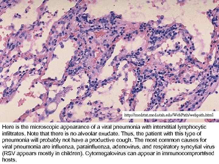 http: //medstat. med. utah. edu/Web. Path/webpath. html Here is the microscopic appearance of a