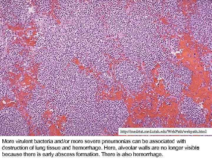 http: //medstat. med. utah. edu/Web. Path/webpath. html More virulent bacteria and/or more severe pneumonias