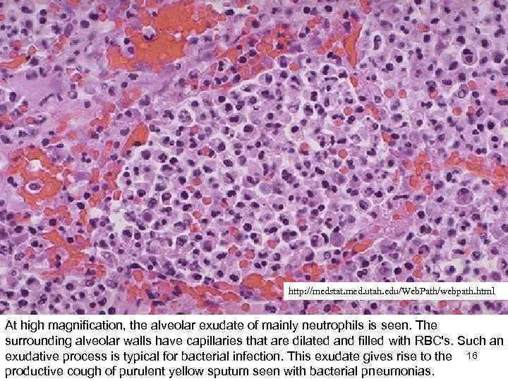 http: //medstat. med. utah. edu/Web. Path/webpath. html At high magnification, the alveolar exudate of