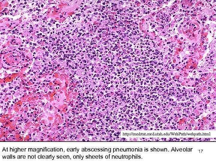 http: //medstat. med. utah. edu/Web. Path/webpath. html At higher magnification, early abscessing pneumonia is