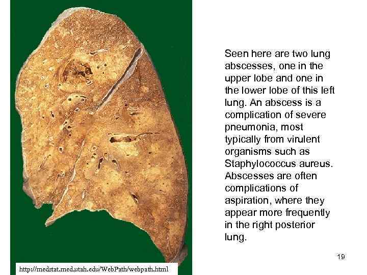 Seen here are two lung abscesses, one in the upper lobe and one in