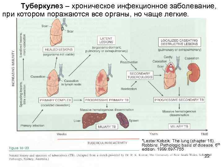 Туберкулез – хроническое инфекционное заболевание, при котором поражаются все органы, но чаще легкие. *Lester