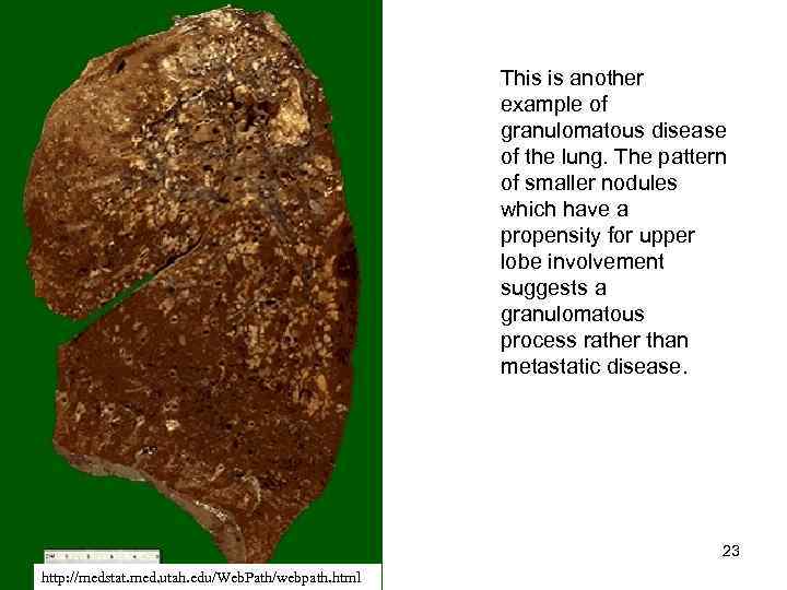 This is another example of granulomatous disease of the lung. The pattern of smaller