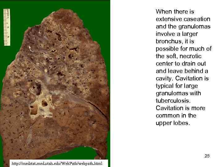 When there is extensive caseation and the granulomas involve a larger bronchus, it is