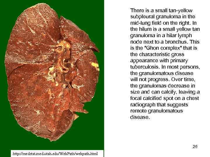 There is a small tan-yellow subpleural granuloma in the mid-lung field on the right.