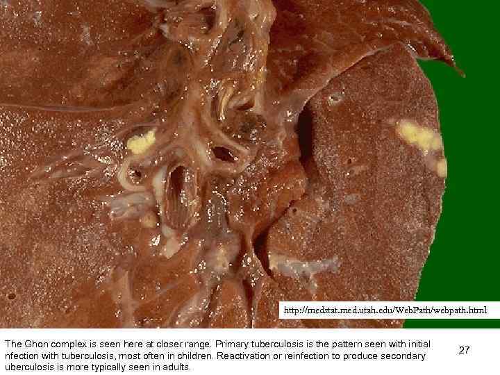 http: //medstat. med. utah. edu/Web. Path/webpath. html The Ghon complex is seen here at