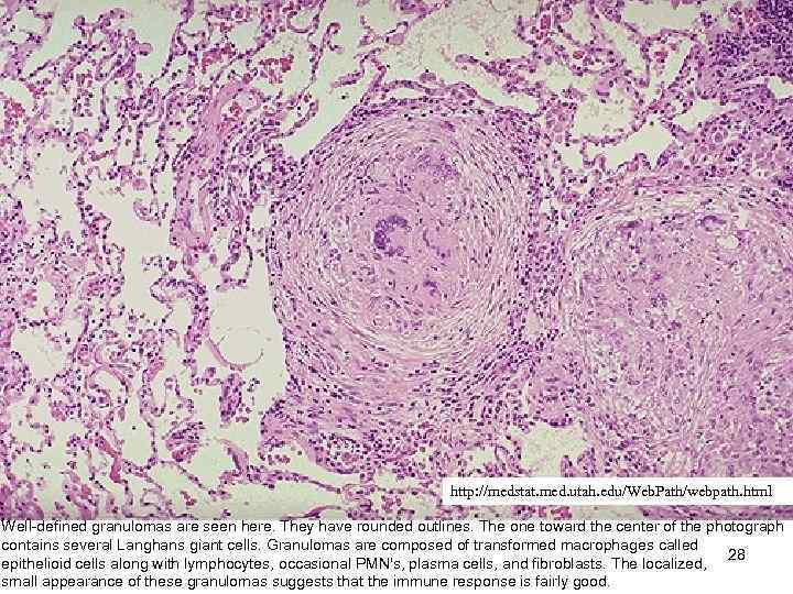 http: //medstat. med. utah. edu/Web. Path/webpath. html Well-defined granulomas are seen here. They have