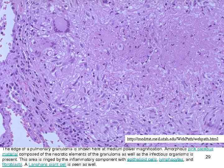 http: //medstat. med. utah. edu/Web. Path/webpath. html The edge of a pulmonary granuloma is