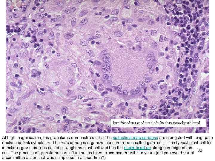 http: //medstat. med. utah. edu/Web. Path/webpath. html At high magnification, the granuloma demonstrates that