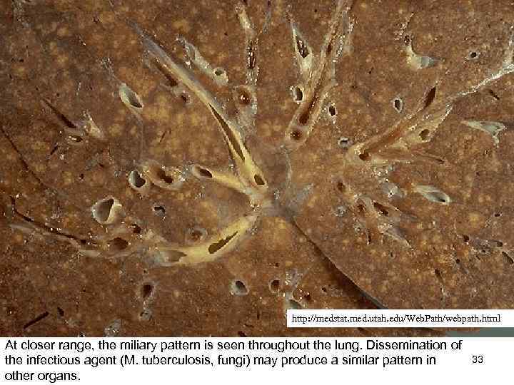 http: //medstat. med. utah. edu/Web. Path/webpath. html At closer range, the miliary pattern is