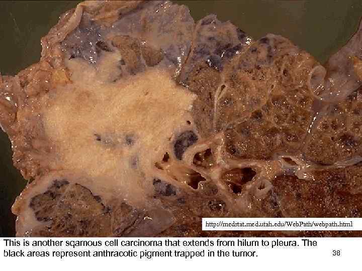 http: //medstat. med. utah. edu/Web. Path/webpath. html This is another sqamous cell carcinoma that