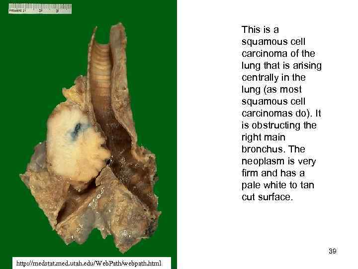 This is a squamous cell carcinoma of the lung that is arising centrally in