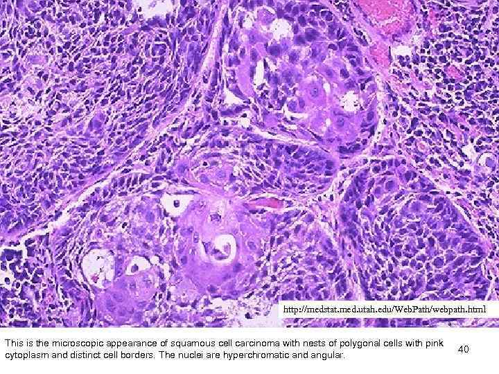 http: //medstat. med. utah. edu/Web. Path/webpath. html This is the microscopic appearance of squamous