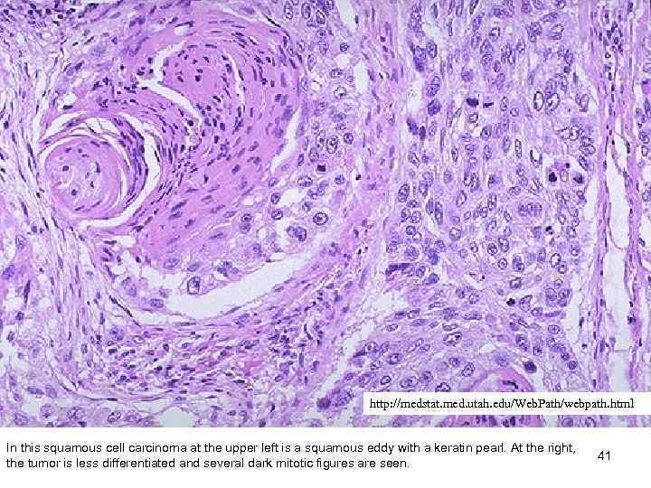 http: //medstat. med. utah. edu/Web. Path/webpath. html In this squamous cell carcinoma at the