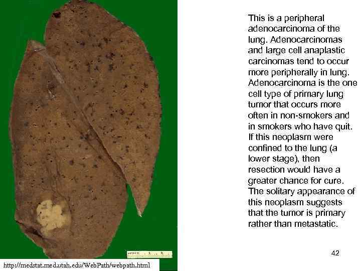  This is a peripheral adenocarcinoma of the lung. Adenocarcinomas and large cell anaplastic