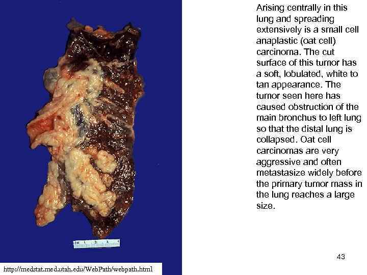 Arising centrally in this lung and spreading extensively is a small cell anaplastic (oat