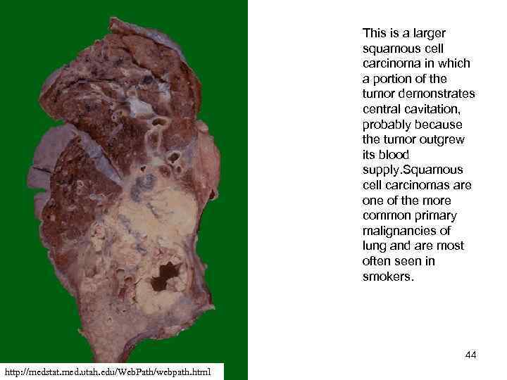  This is a larger squamous cell carcinoma in which a portion of the