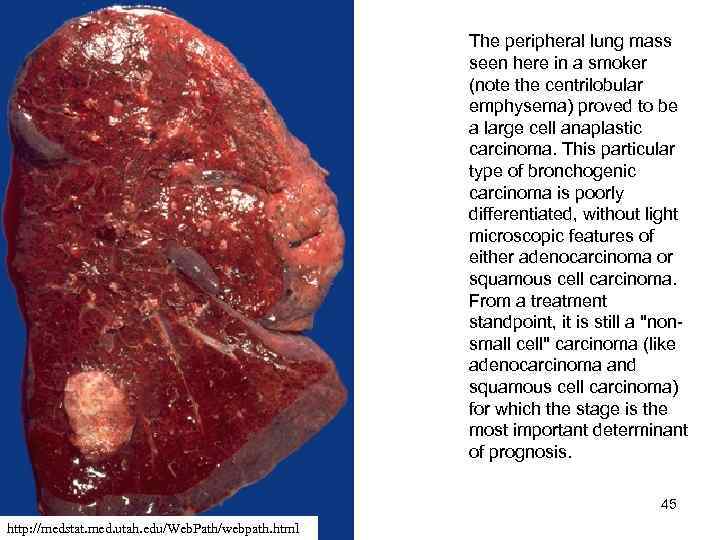 The peripheral lung mass seen here in a smoker (note the centrilobular emphysema) proved