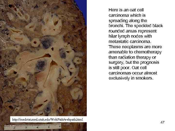 Here is an oat cell carcinoma which is spreading along the bronchi. The speckled