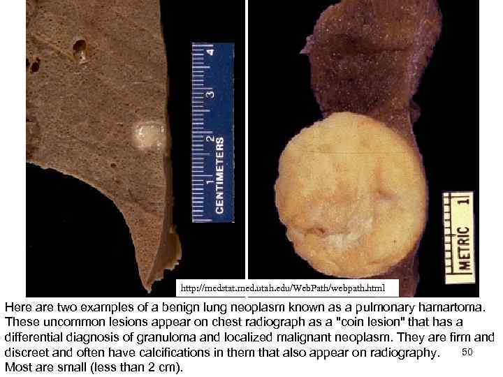 http: //medstat. med. utah. edu/Web. Path/webpath. html Here are two examples of a benign