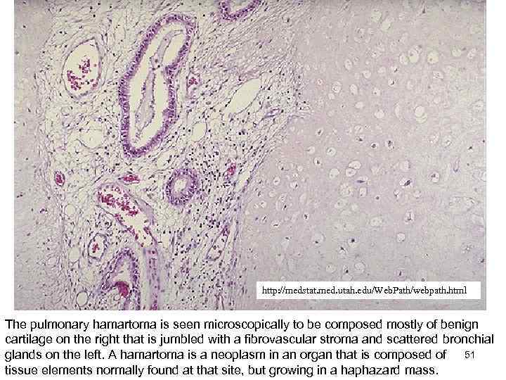 http: //medstat. med. utah. edu/Web. Path/webpath. html The pulmonary hamartoma is seen microscopically to