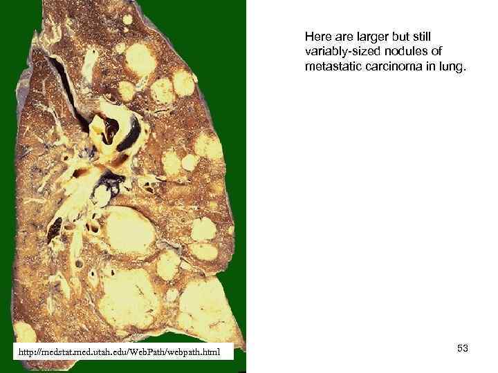 Here are larger but still variably-sized nodules of metastatic carcinoma in lung. http: //medstat.