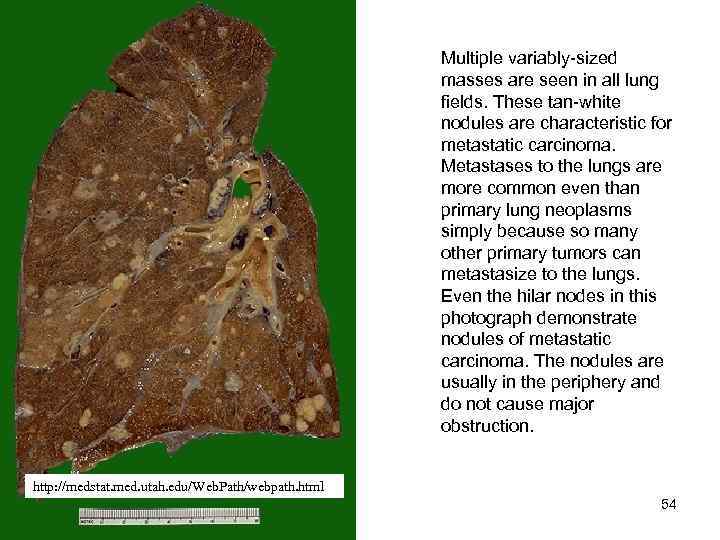 Multiple variably-sized masses are seen in all lung fields. These tan-white nodules are characteristic