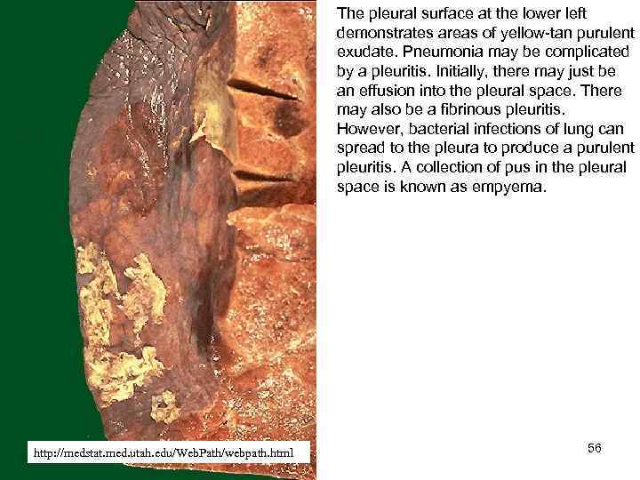 The pleural surface at the lower left demonstrates areas of yellow-tan purulent exudate. Pneumonia