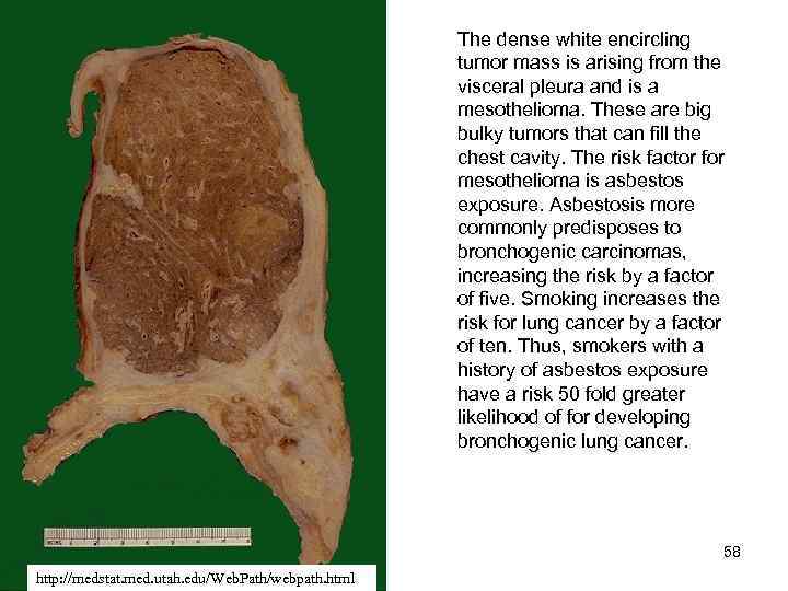 The dense white encircling tumor mass is arising from the visceral pleura and is