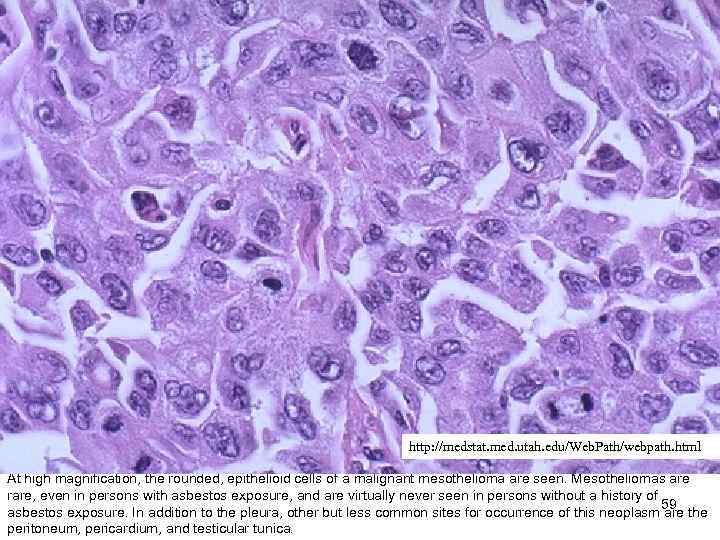 http: //medstat. med. utah. edu/Web. Path/webpath. html At high magnification, the rounded, epithelioid cells