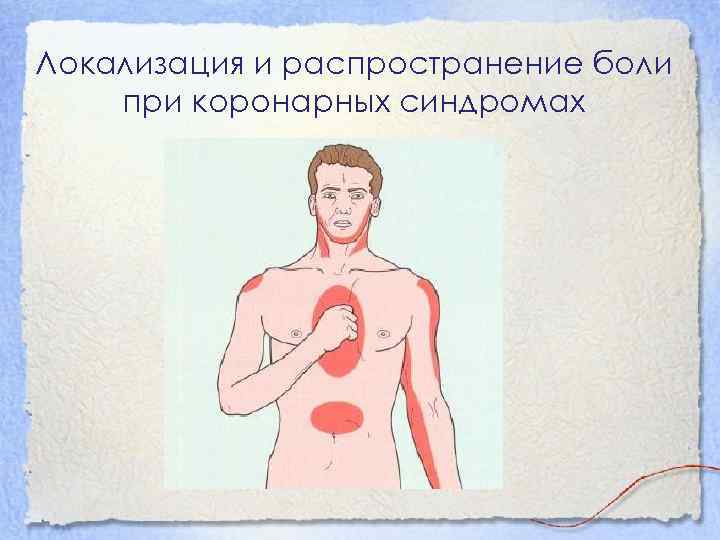 Локализация и распространение боли при коронарных синдромах 