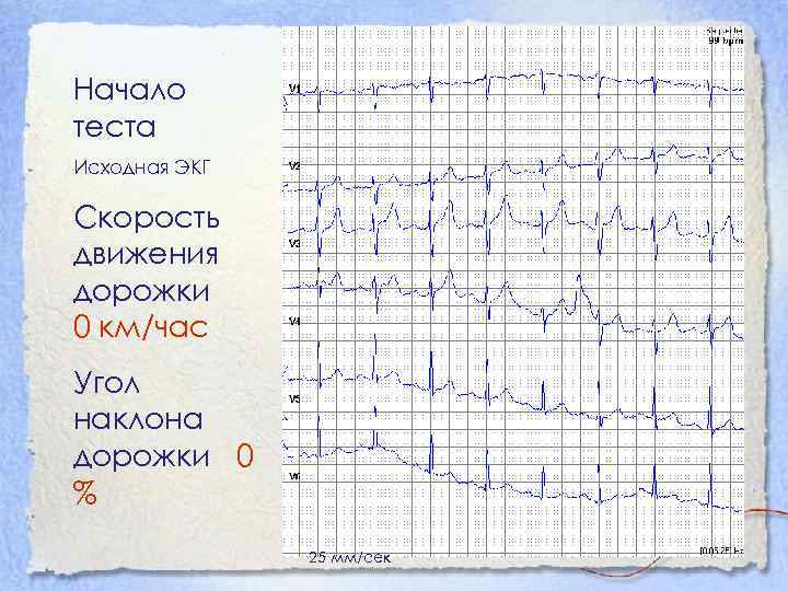 Начало теста Исходная ЭКГ Скорость движения дорожки 0 км/час Угол наклона дорожки 0 %