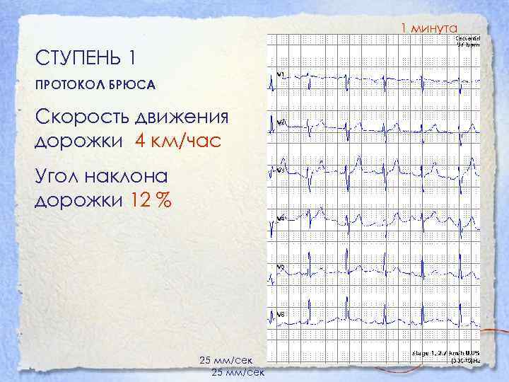 1 минута СТУПЕНЬ 1 ПРОТОКОЛ БРЮСА Скорость движения дорожки 4 км/час Угол наклона дорожки