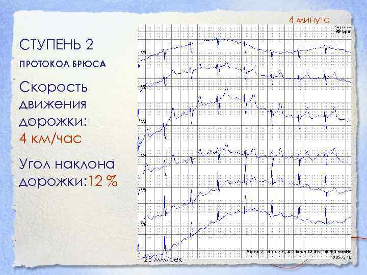 4 минута СТУПЕНЬ 2 ПРОТОКОЛ БРЮСА Скорость движения дорожки: 4 км/час Угол наклона дорожки: