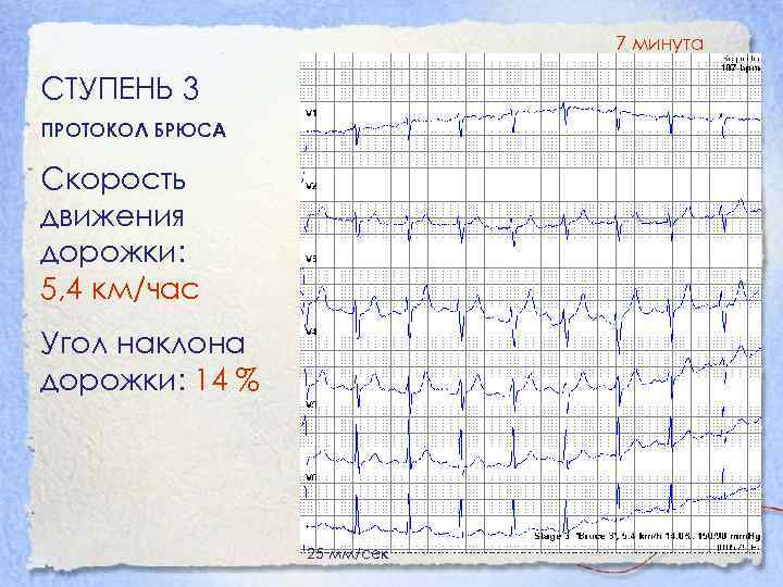 7 минута СТУПЕНЬ 3 ПРОТОКОЛ БРЮСА Скорость движения дорожки: 5, 4 км/час Угол наклона