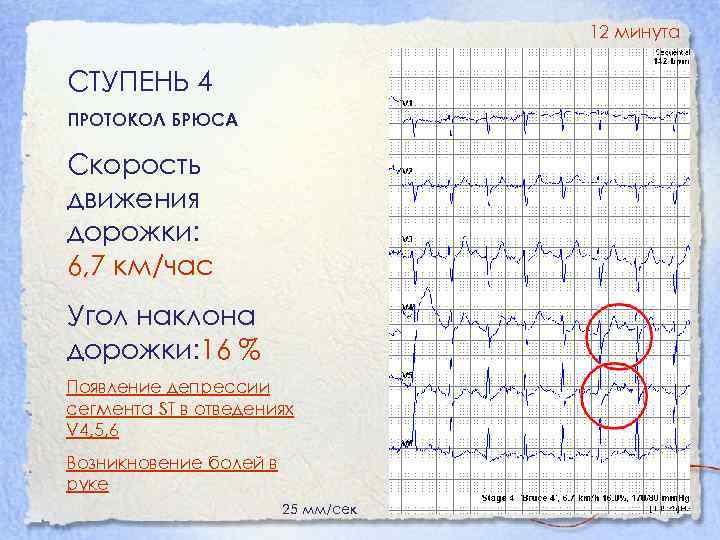 12 минута СТУПЕНЬ 4 ПРОТОКОЛ БРЮСА Скорость движения дорожки: 6, 7 км/час Угол наклона
