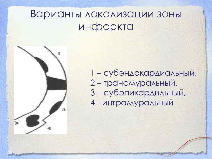 Варианты локализации зоны инфаркта 1 – субэндокардиальный, 2 – трансмуральный, 3 – субэпикардильный, 4