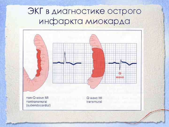 ЭКГ в диагностике острого инфаркта миокарда 