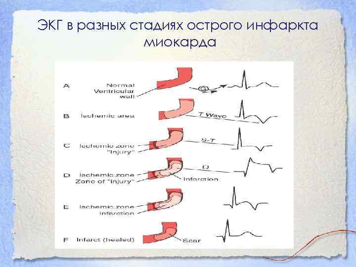 ЭКГ в разных стадиях острого инфаркта миокарда 
