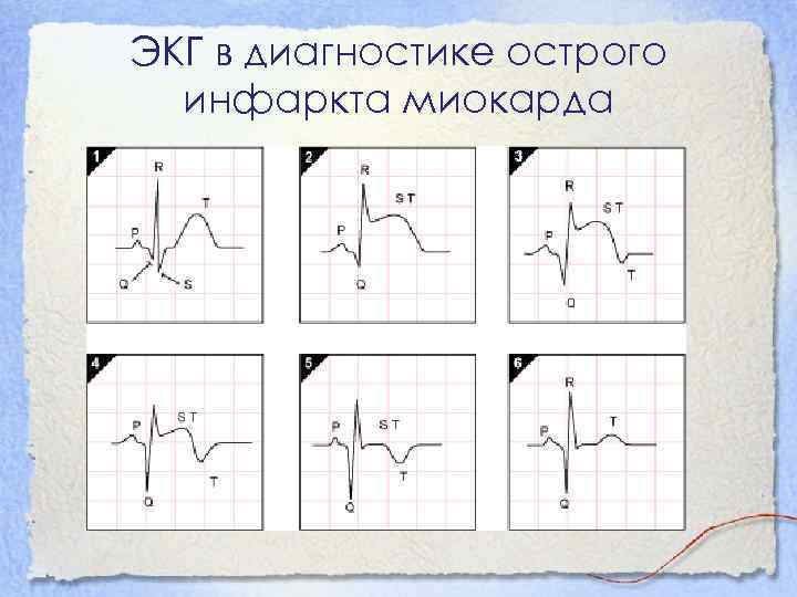 ЭКГ в диагностике острого инфаркта миокарда 