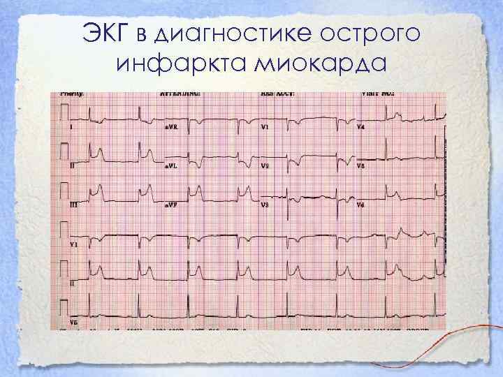 ЭКГ в диагностике острого инфаркта миокарда 