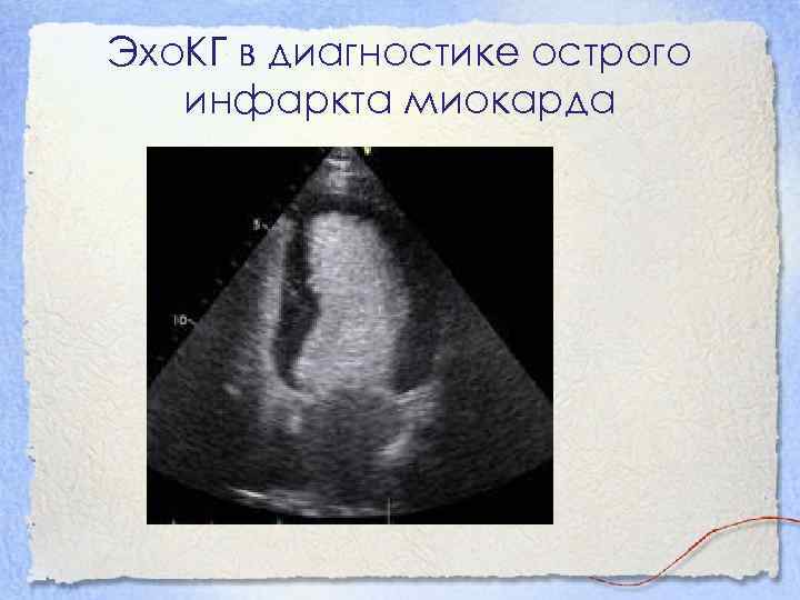 Эхо. КГ в диагностике острого инфаркта миокарда 