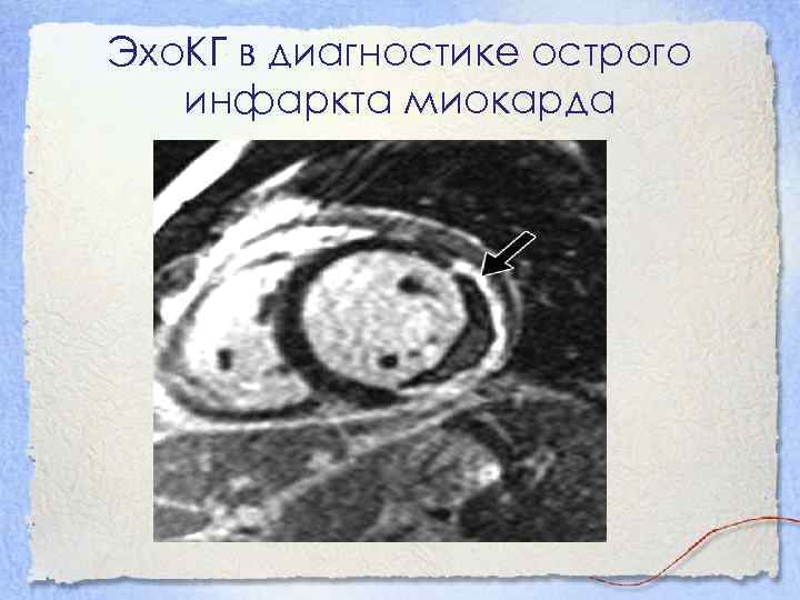 Эхо. КГ в диагностике острого инфаркта миокарда 