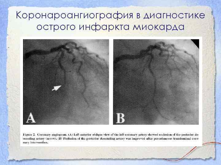 Коронарография при инфаркте миокарда. Коронарные сосуды коронарография. Коронарография стеноз.