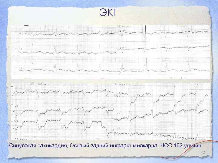 ЭКГ Синусовая тахикардия, Острый задний инфаркт миокарда, ЧСС 102 уд/мин 72 